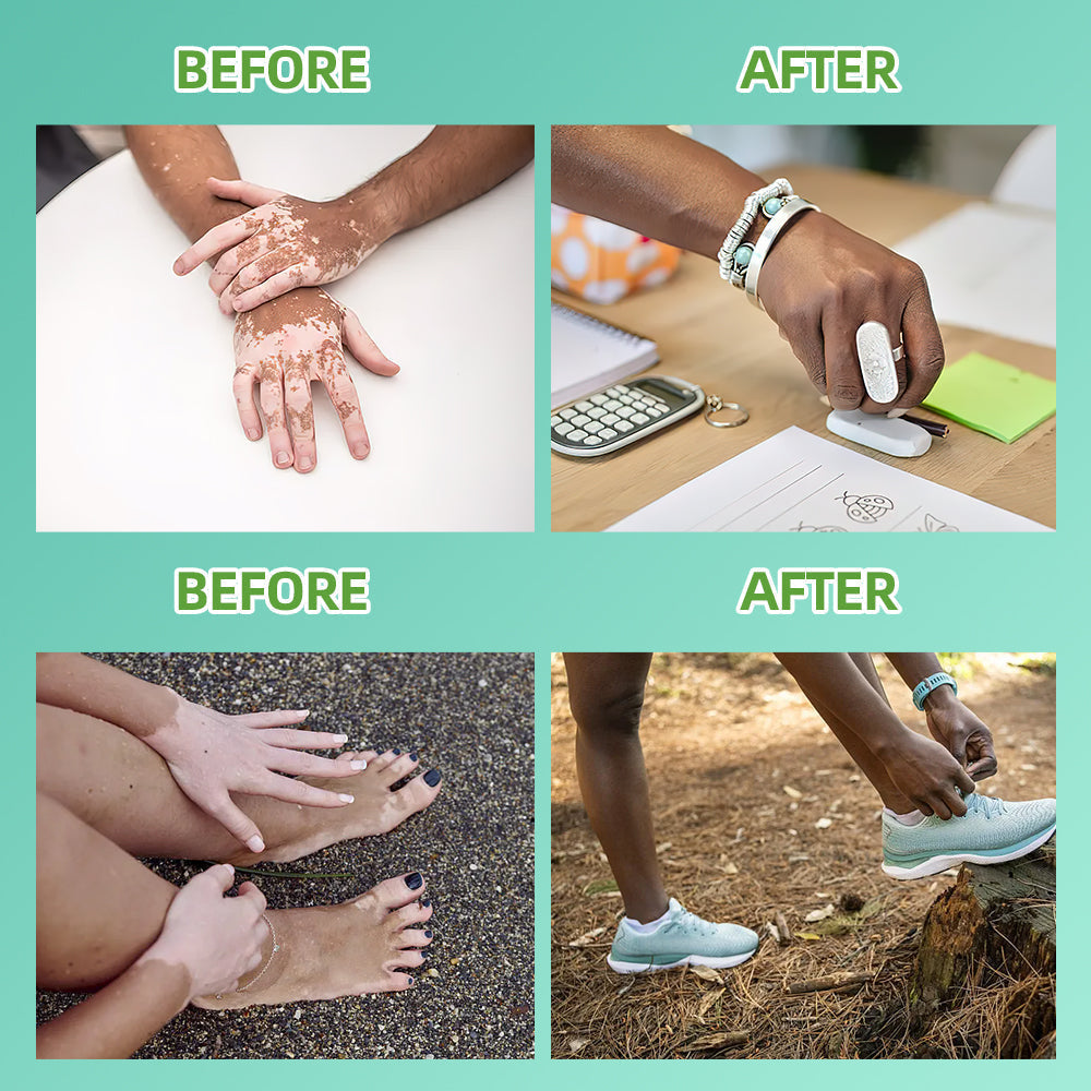 311nm UVB Light Therapy for Psoriasis and Vitiligo
