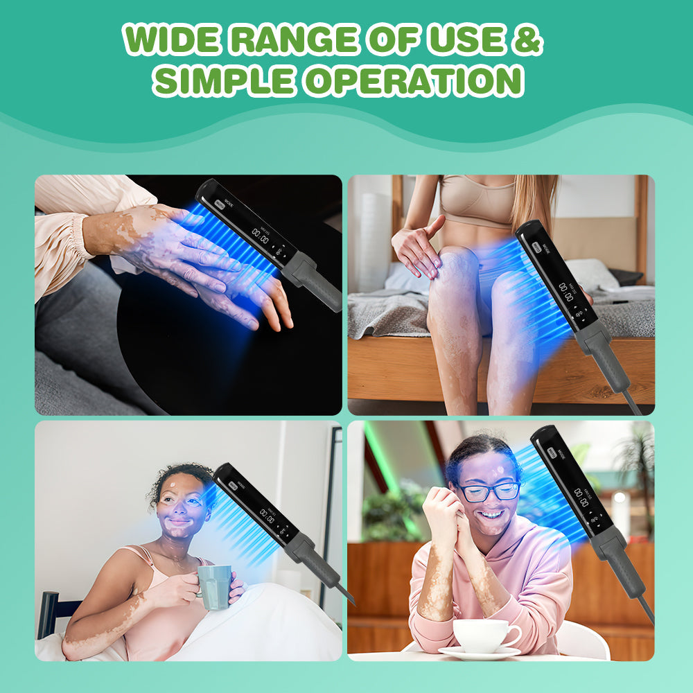 Home Use 311nm UVB Light Therapy for Psoriasis and Vitiligo