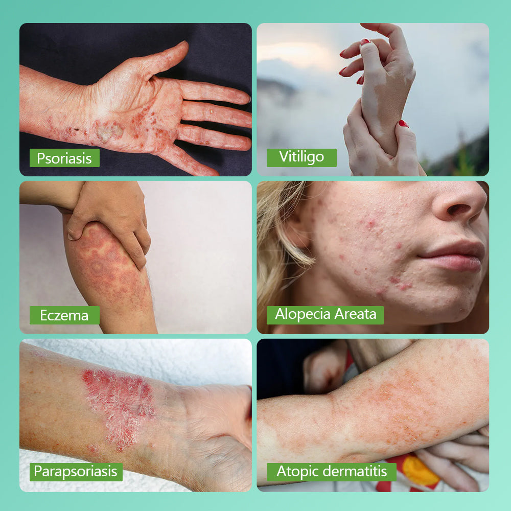 Home Use 311nm UVB Light Therapy for Psoriasis and Vitiligo