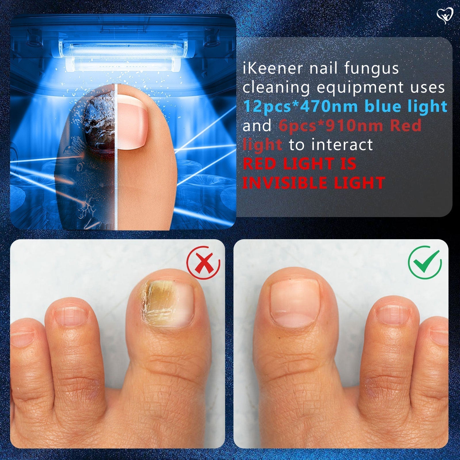 Toenail Fungus Light Therapy for Multiple Toenails