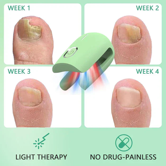 Nail Fungus Laser Therapy Device For Toenail Treatment