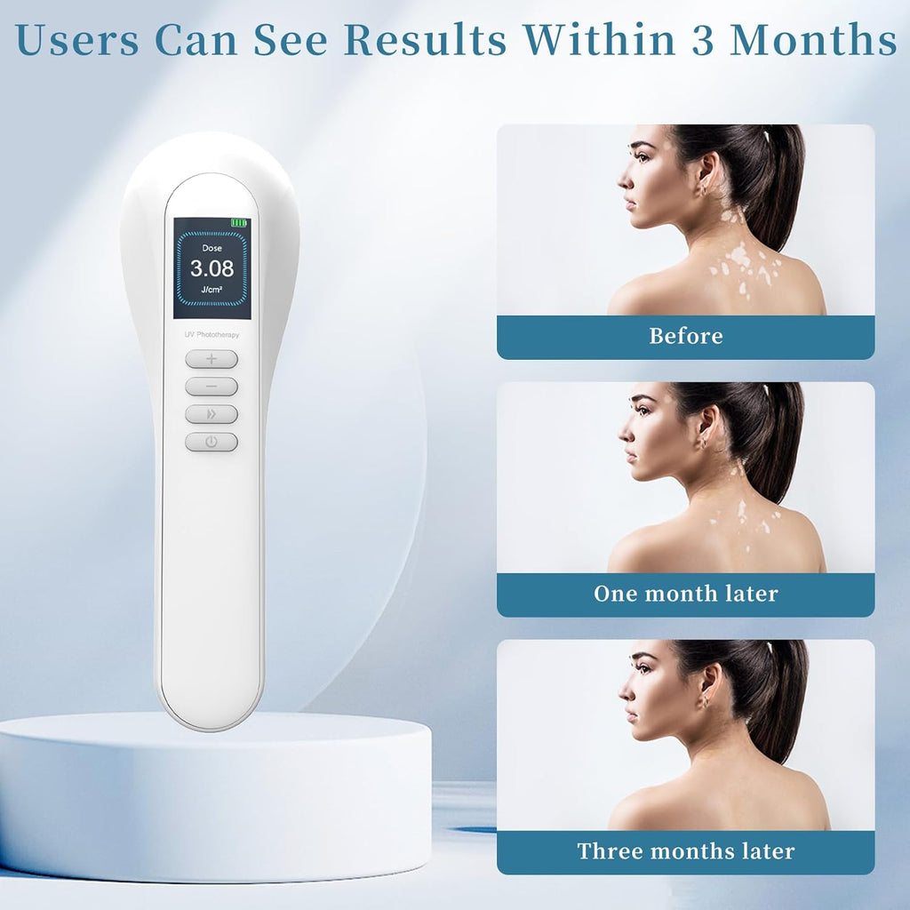 308nm UV Light Phototherapy LED Lamp for Home Use Model