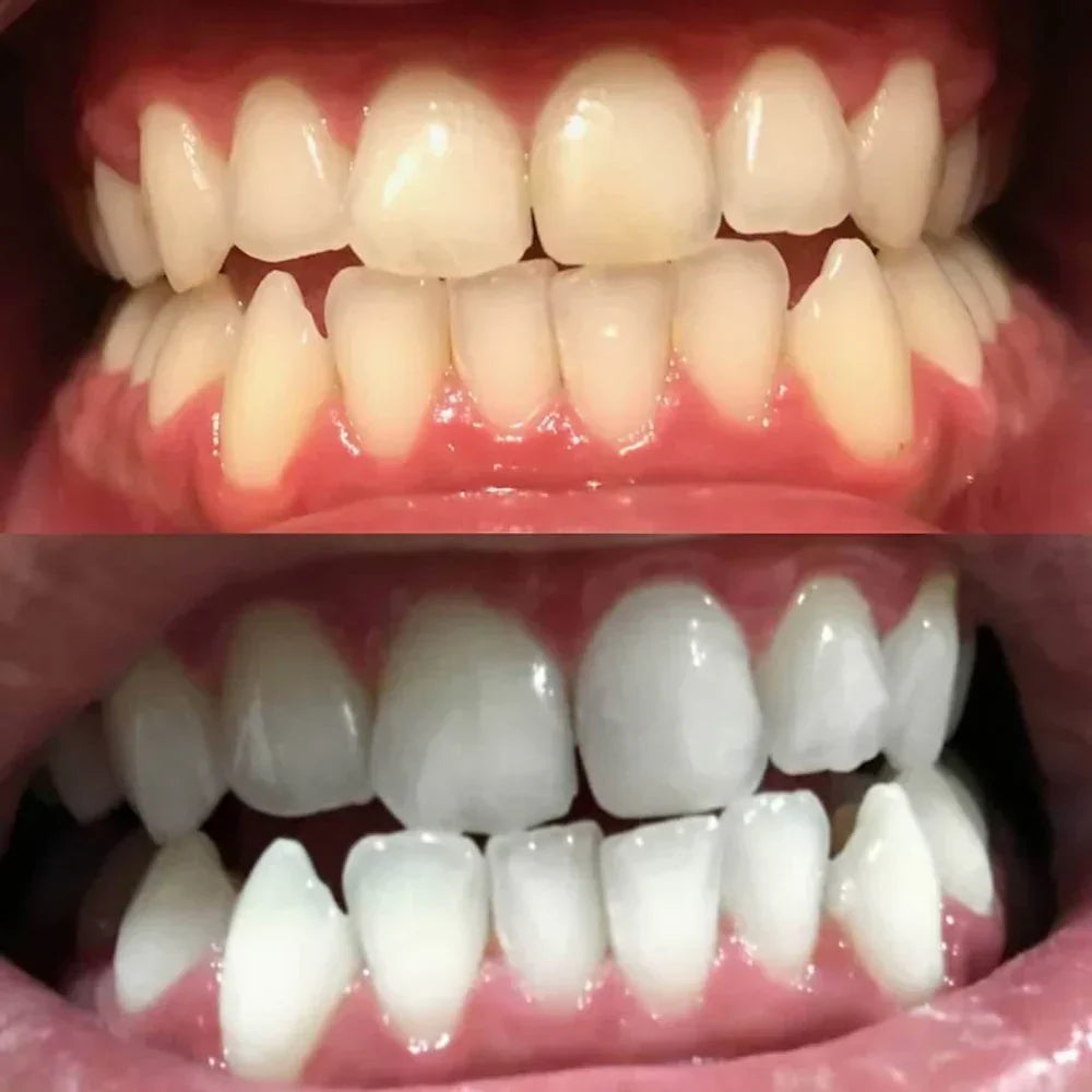Stylo blanchissant pour dents avec correction de couleur pour usage quotidien à domicile