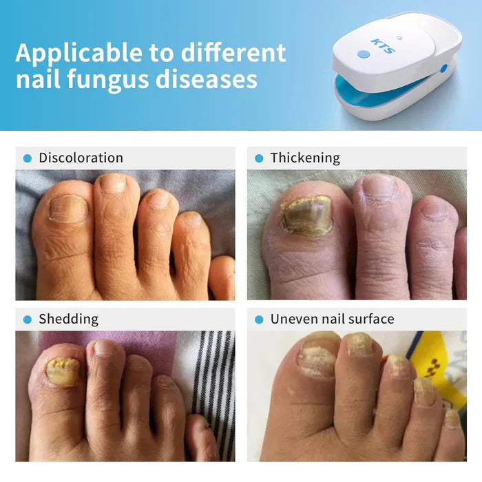 Sistema di Terapia Laser LuminNail per Funghi delle Unghie - Collezione Unghie