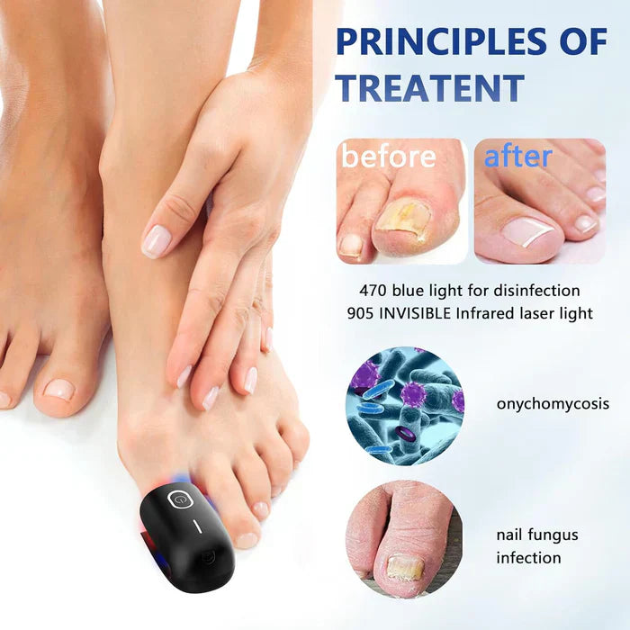 Nail Fungus Laser Therapy Device For Toenail Treatment