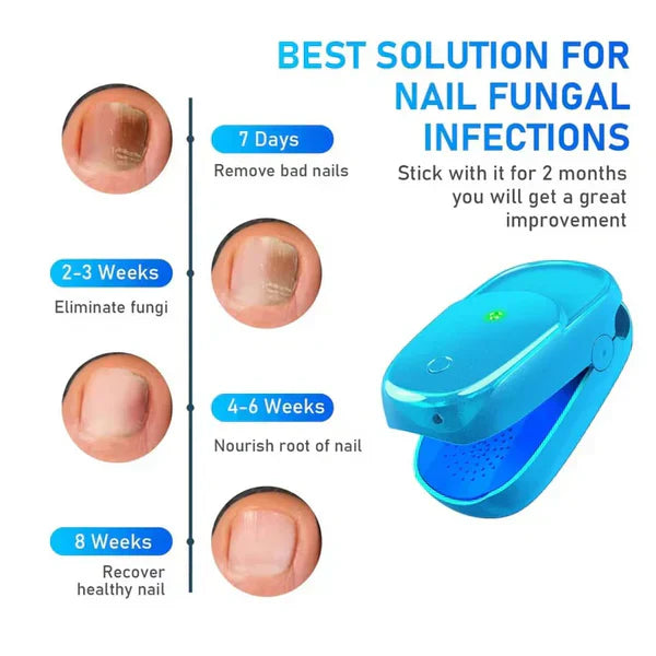 Ny laserbehandlingsenhed mod onychomykose til neglesvamp