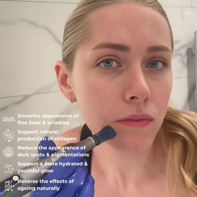 NovaDerm M8S Penna per Microneedling per il Ringiovanimento della Pelle