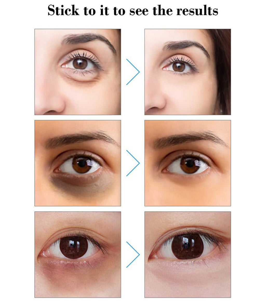Hyaluronic Acid Microneedle Eye Patch For Under Eye Care