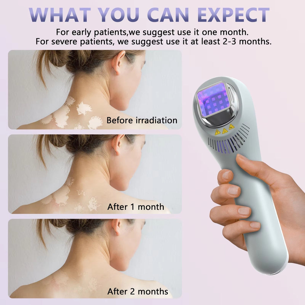 308 Nm UVB Phototherapy Light For Face, Neck, And Limbs