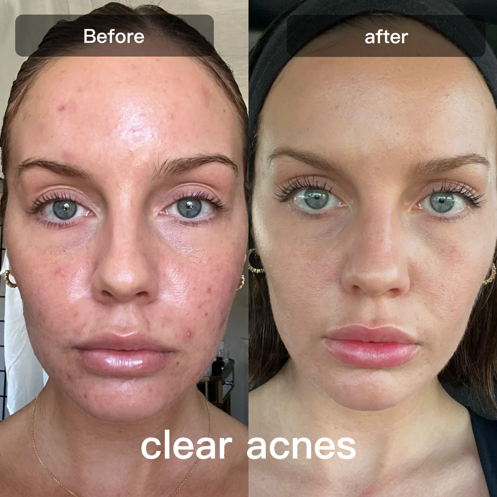 LED Light Therapy Device for Facial and Body Skin Care