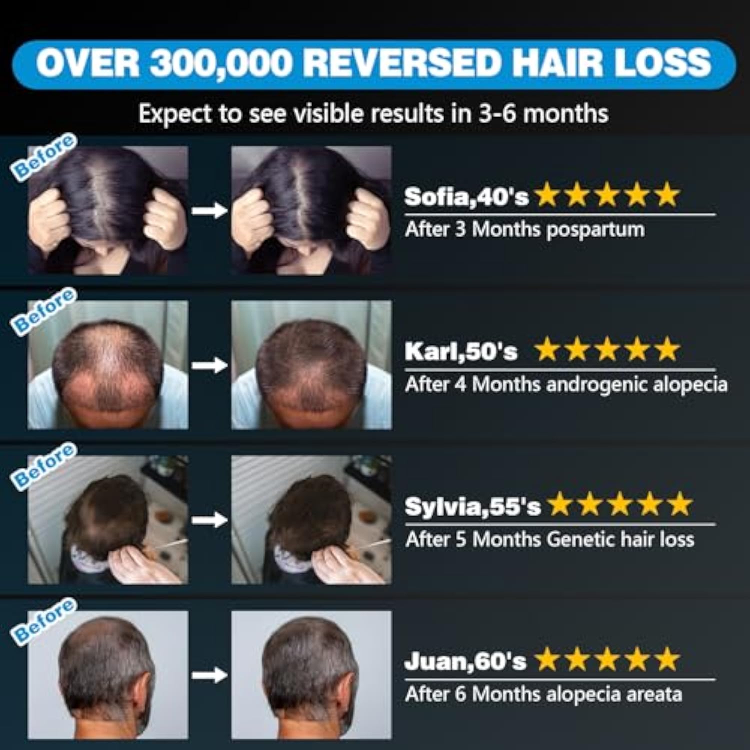 Pro Laser Hair Regrowth Cap 1.0 Pro Edition for Scalp Use